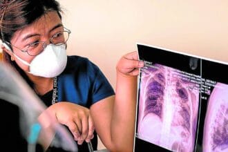 TB is primary cause of death among people with HIV